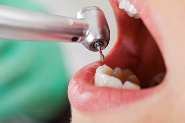 Best Emergency Dental Care for Broken or Chipped Teeth in Fox Chapel, PA